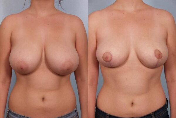 Breast Reduction 18