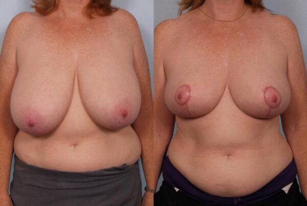 Breast Reduction 19