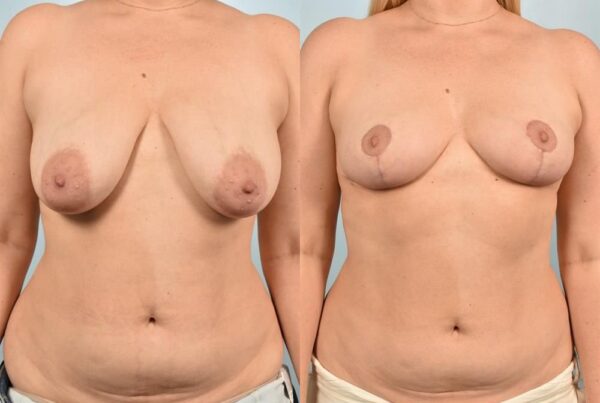 Breast Reduction 2