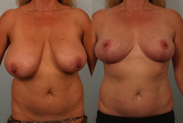 Breast Reduction 20