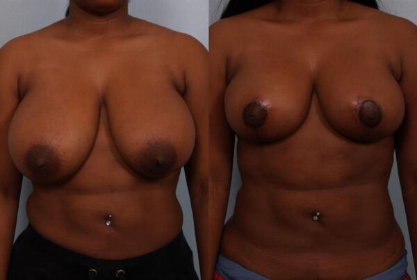 Breast Reduction 21