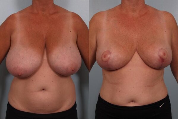 Breast Reduction 22