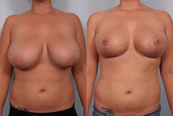 Breast Reduction 23