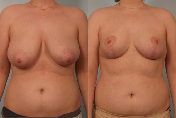 Breast Reduction 24