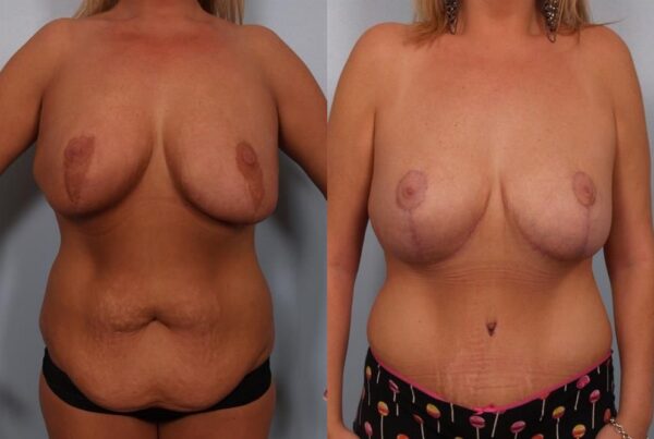 Breast Reduction 25