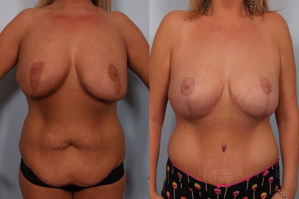 Breast Reduction 25