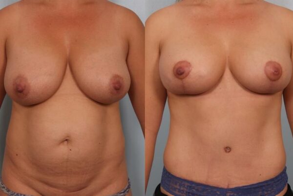 Breast Reduction 26