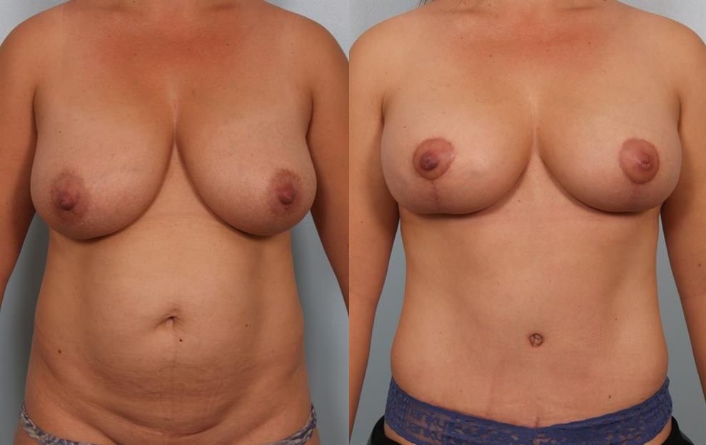 Breast Reduction 26