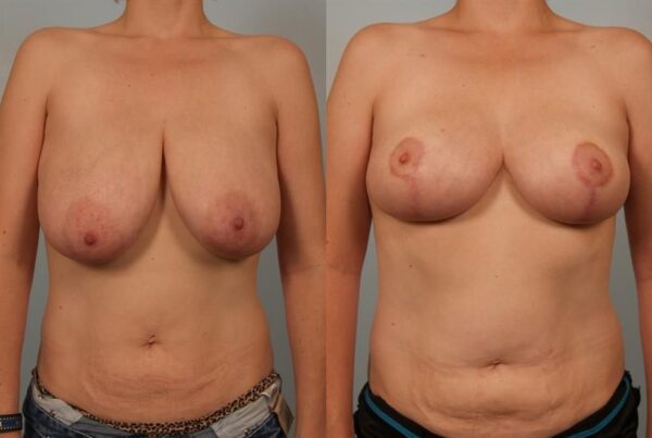 Breast Reduction 27