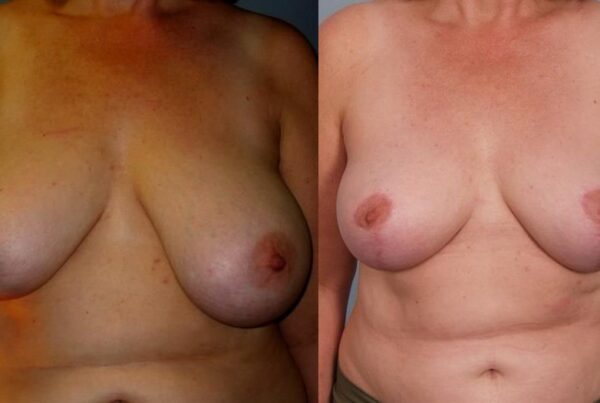 Breast Reduction 28