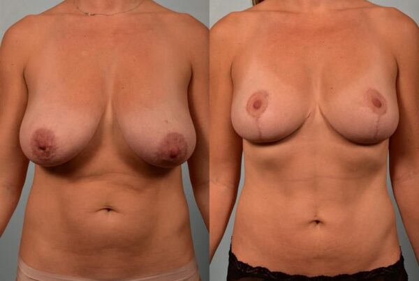 Breast Reduction 3