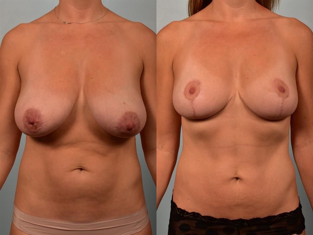 Breast Reduction 3