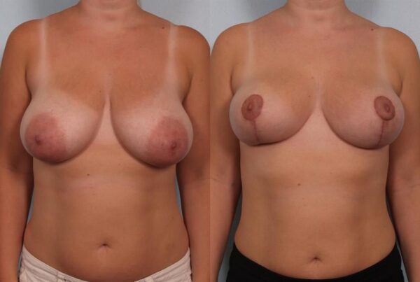 Breast Reduction 30