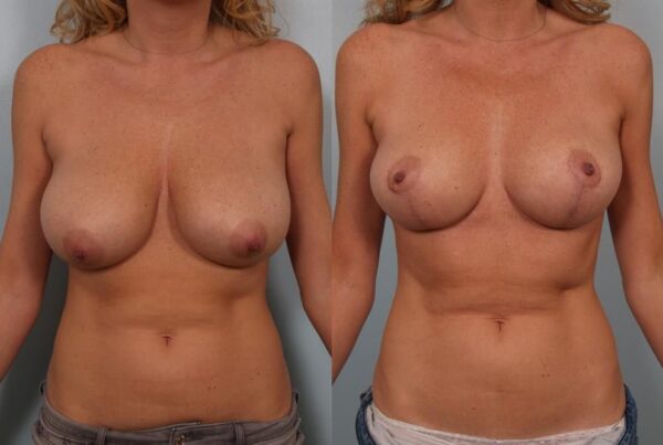 Breast Reduction 31