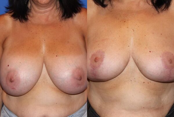 Breast Reduction 32