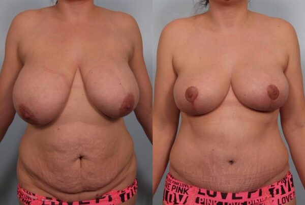 Breast Reduction 33