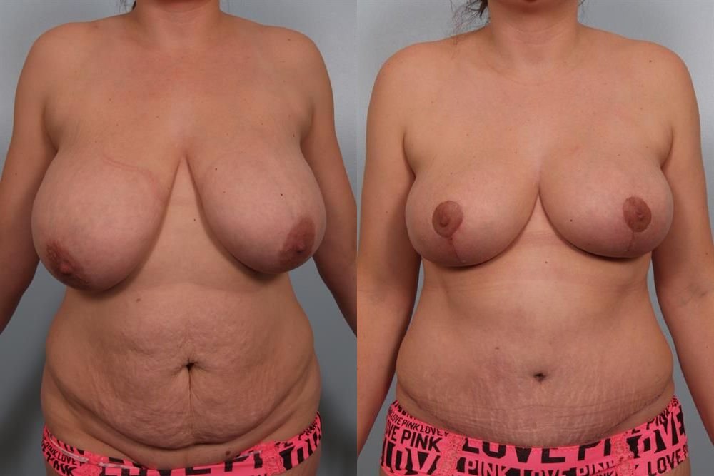 Breast Reduction 33