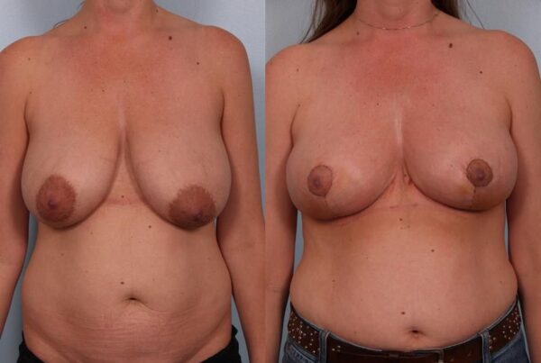 Breast Reduction 34