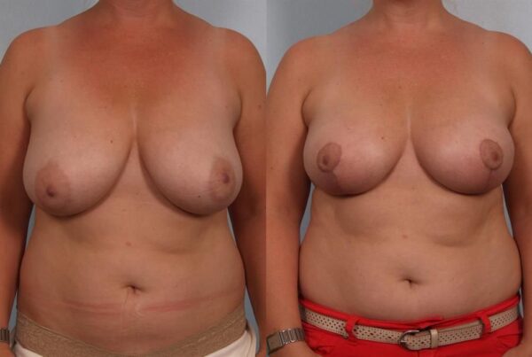 Breast Reduction 35