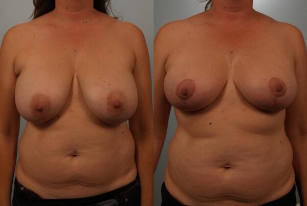 Breast Reduction 36