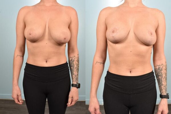 Breast Reduction 37