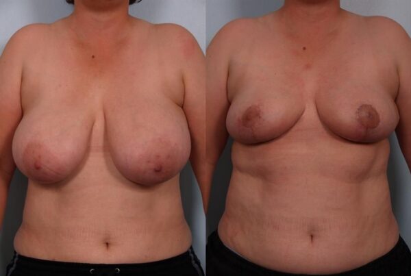 Breast Reduction 38