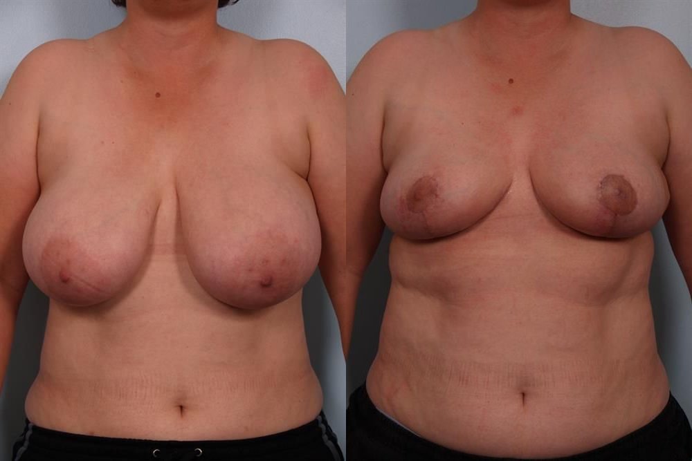 Breast Reduction 38