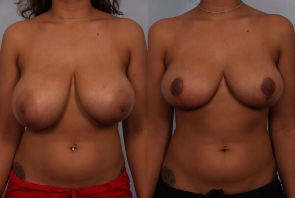 Breast Reduction 39