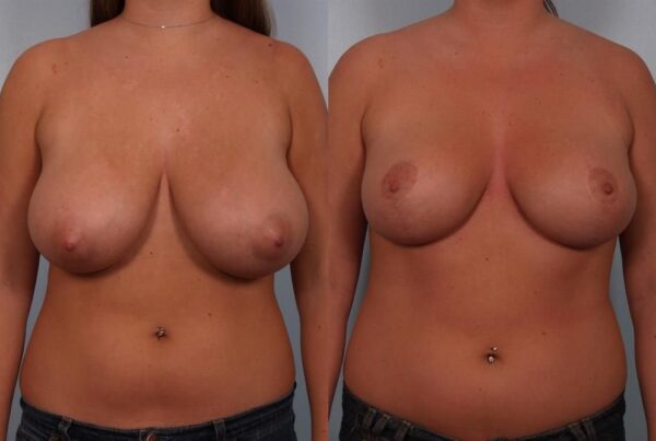 Breast Reduction 4