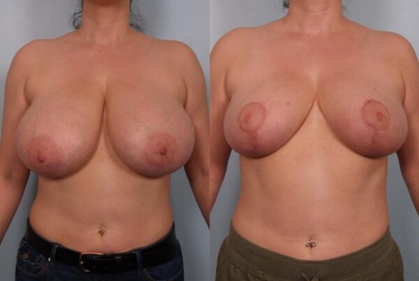 Breast Reduction 40