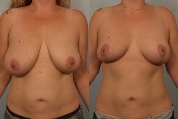Breast Reduction 41