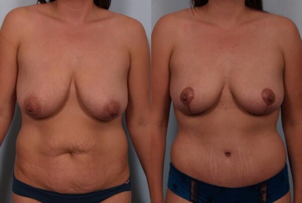 Breast Reduction 42