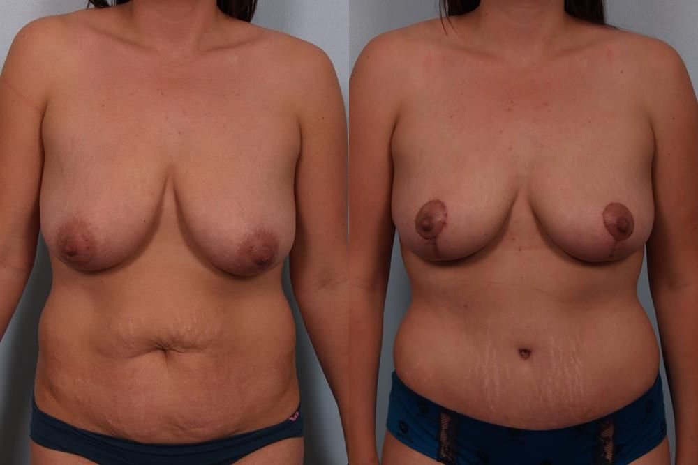 Breast Reduction 42