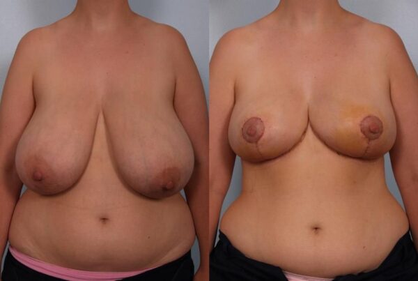 Breast Reduction 43