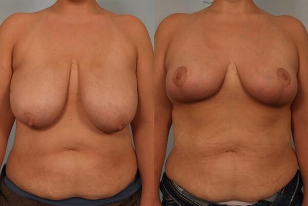 Breast Reduction 44