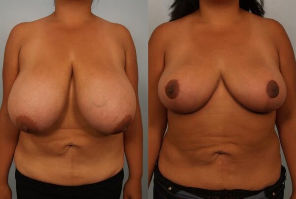 Breast Reduction 45