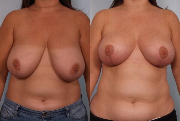 Breast Reduction 46
