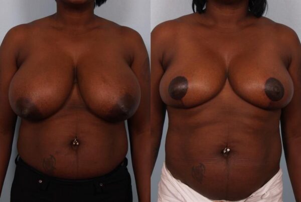 Breast Reduction 47