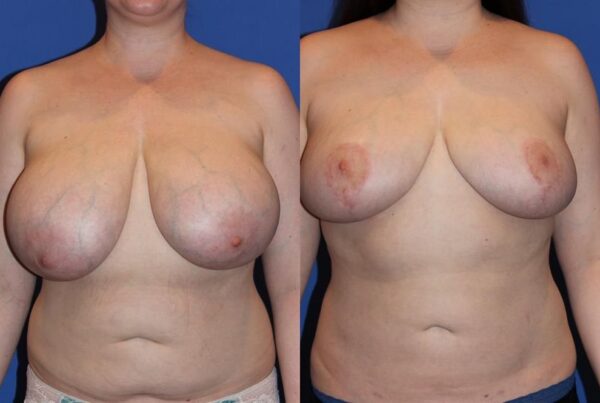 Breast Reduction 48