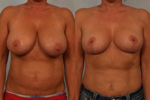 Breast Reduction 49