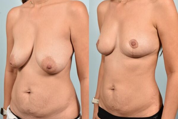 Breast Reduction 5
