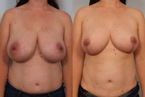 Breast Reduction 50