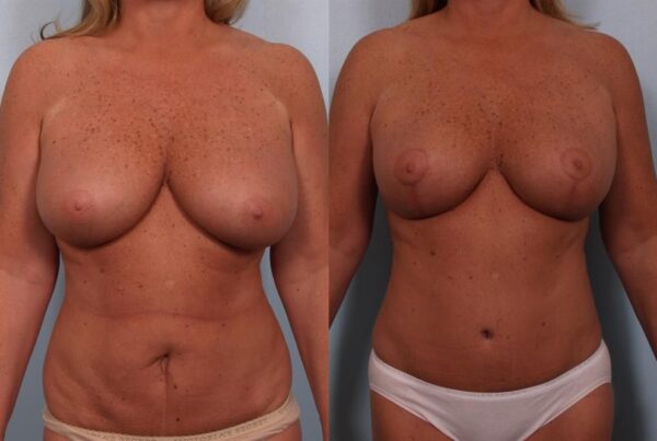 Breast Reduction 51