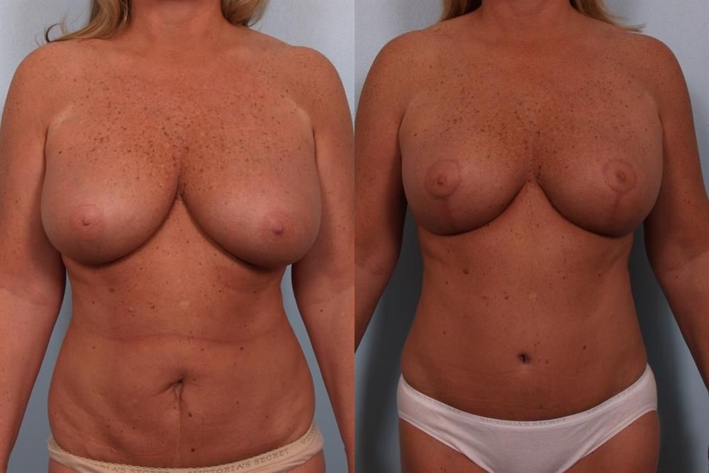 Breast Reduction 51