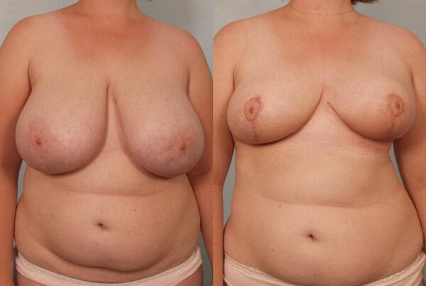 Breast Reduction 52