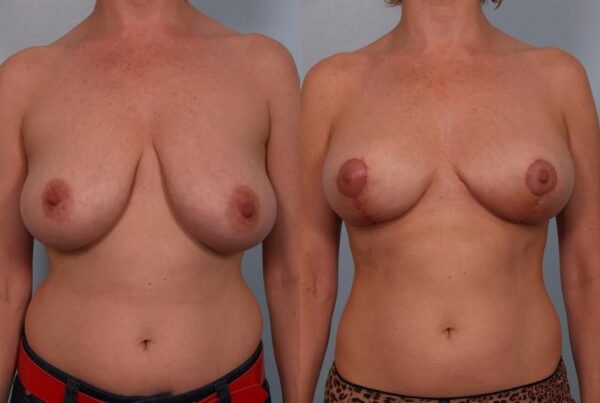 Breast Reduction 53