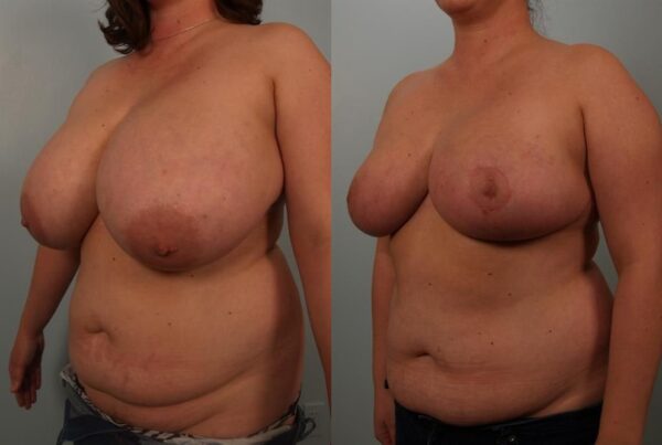 Breast Reduction 54