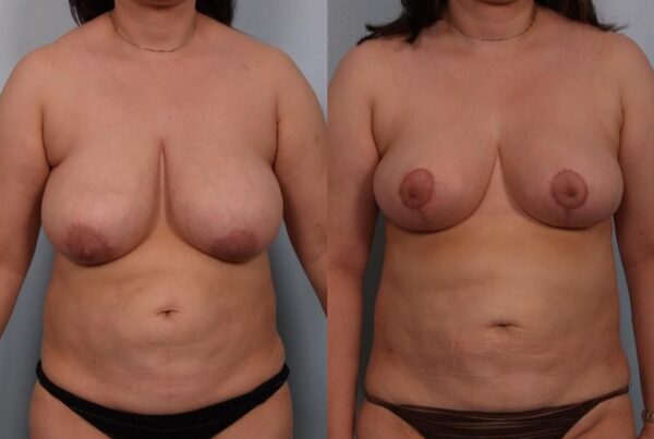 Breast Reduction 55
