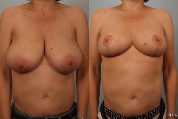 Breast Reduction 56