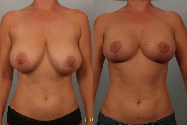 Breast Reduction 57